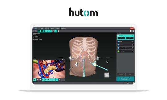 세계 최초 로봇 복강경 수술 내비게이션 RUS /사진=휴톰